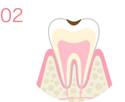C1＊虫歯レベル1