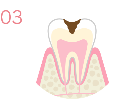 C2＊虫歯レベル2