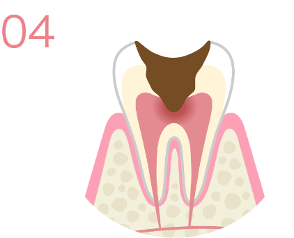 C3＊虫歯レベル3