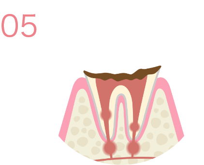 C4＊虫歯レベル4